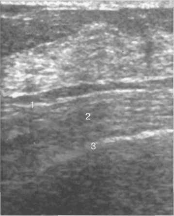 Что такое фиброгландулярная ткань молочной. Что такое фиброгландулярная ткань молочной. Толщина паренхимы молочной железы узи. Ультразвуковая анатомия молочных желез. Типы строения молочной железы по узи.
